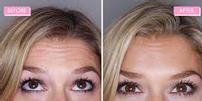 Botox for 2 Facial Areas 202//101
